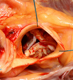 大動脈弁狭窄症の大動脈弁を覗き込んだところ