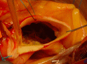 大動脈弁狭窄症の手術画像1