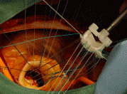 大動脈弁狭窄症の手術画像2